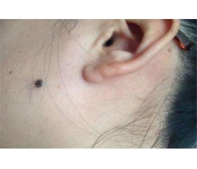 痣上长毛能拔吗？都有哪些痣不能拔毛？