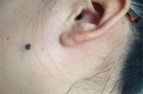 痣上长毛能拔吗?都有哪些痣不能拔毛?